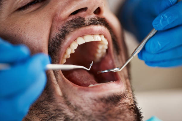 Best Emergency Dentist for Lost Fillings or Crowns in Trenton, MI